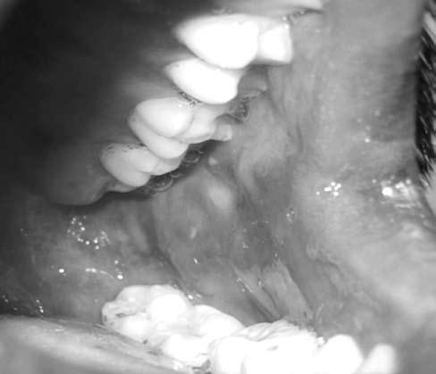 Two new lesions, which were not present during the initial examination, were seen on both the left and right sides of buccal mucosa, adjacent to the upper canine and premolars (Figs.