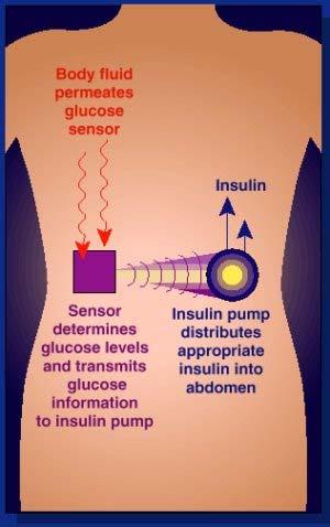 On The Path Towards An Artificial Pancreas A closed loop system with