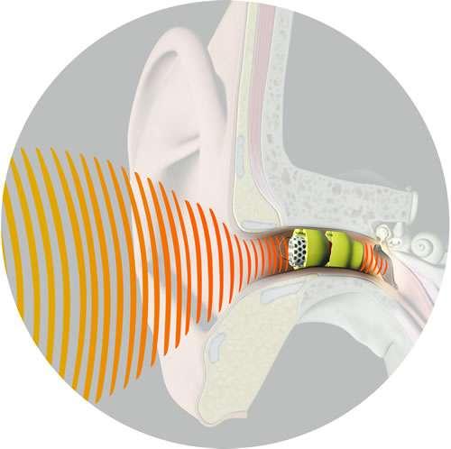 Extended Wear Hearing Aid Lyric Lasts for up to 120 days and is programmable by Ear Nose