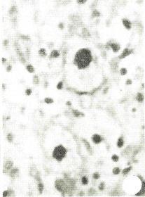 River similar descriptions in Colombia and Peru as eraly as 1934 Labrea Hepatitis: Morula-Like Cells 2.