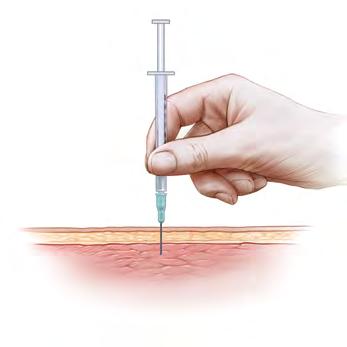 INTRAMUSCULAR INJECTION ONLY INTRAMUSCULAR INJECTION ONLY 4. Hold the syringe like a pencil or dart with your right hand if you are right-handed and your left if you are left-handed.