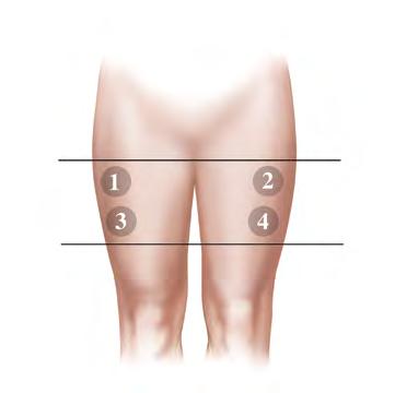 SUBCUTANEOUS INJECTION ONLY SUBCUTANEOUS INJECTION ONLY Injecting the upper thigh The following instructions are for self-injections.