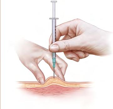 SUBCUTANEOUS INJECTION ONLY SUBCUTANEOUS INJECTION ONLY 4. Hold the syringe like a pencil or dart with your right hand if you are right-handed and your left if you are left-handed.