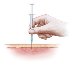 INTRAMUSCULAR INJECTION ONLY 4. Hold the syringe like a pencil or dart with your right hand if you are right-handed and your left if you are left-handed.