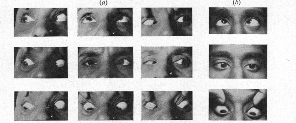 "A" AND "V" PHENOMENA FIG. 6 (a).-impure "A" and "V" phenomena pattern (ii). Right eye hypertropic in all the right fields and left eye in all the left fields of gaze. FIG. 6 (b).