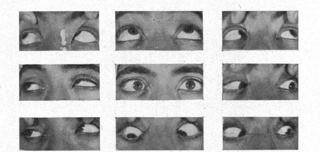 A boy aged 13 years was admitted on February 26, 1962, with a history of alternating concomitant convergent squint since childhood.