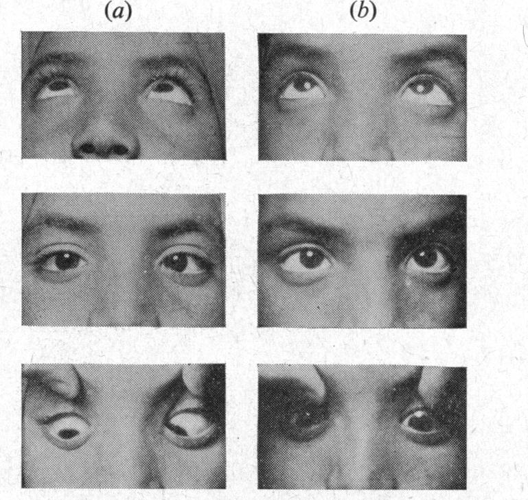 u_... "A" AND "V" PHENOMENA 721 TYPE (1) ESOTROPIA "V" Esotropia.-This was the condition most frequently encountered, 27 cases (50 per cent.) being of this type.