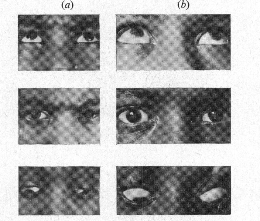 724 D. SINGH, G. SINGH, L. P. AGGARWAL, AND P. CHANDRA "A" Exotropia.-In four cases (7 per cent.), the exodeviation was greater on looking down, with no vertical incomitance.