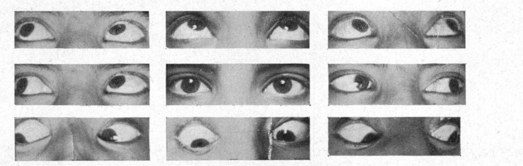 The deviation in the primary position was 450 esotropia which decreased to 35 on looking up and increased to 550 on looking down.