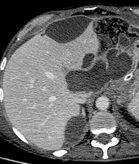 Adrenal Abscess 47 y.o.