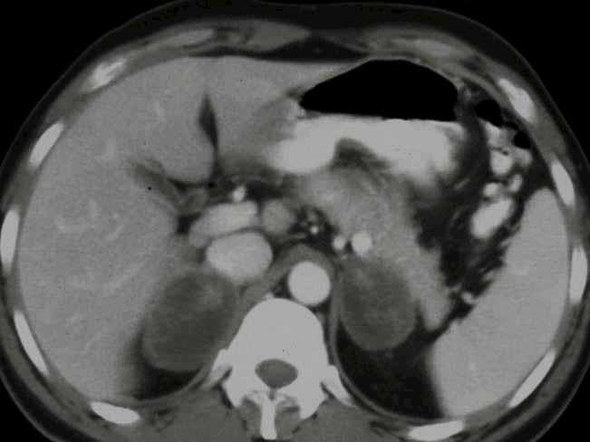 Bilateral adrenal masses on CT.
