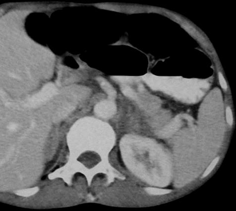 Adrenal Tuberculosis Presentation Two months later Patient with bilateral tuberculous (TB)