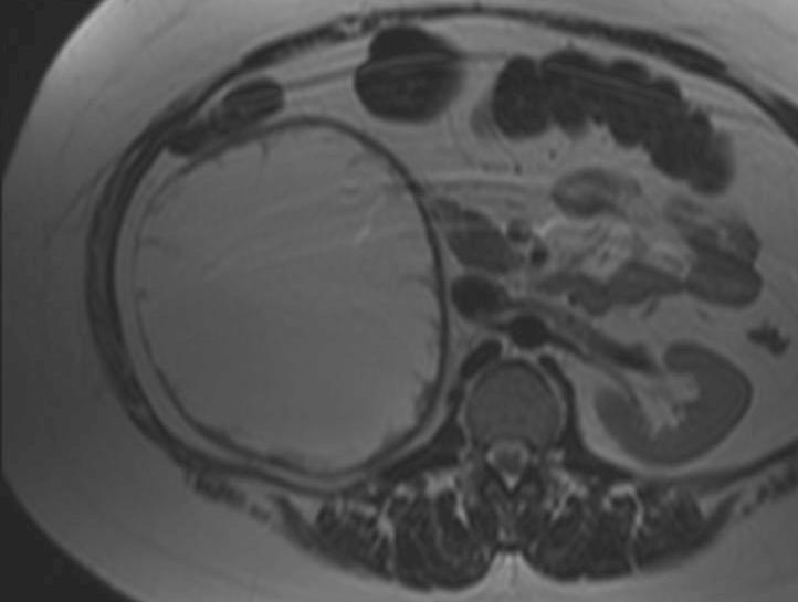 mass without mural nodule or thick