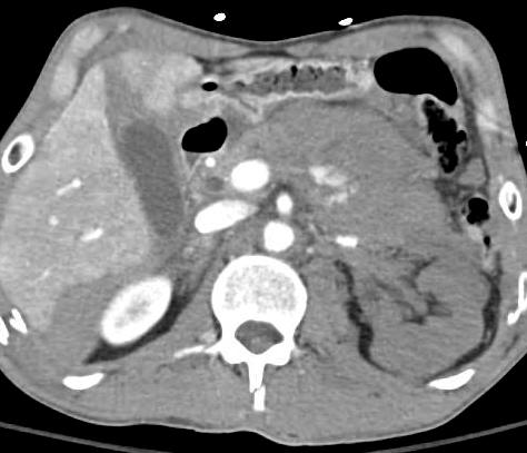 kidney and mesenteric hematoma with active extravasation.
