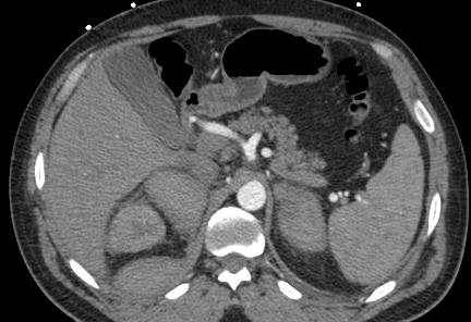 Follow up CT was performed 6 days later due to left