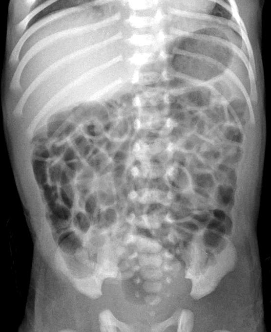 Hee Jung Lee Plain Abdominal Radiography in Infants and Children ㆍ133 air on both sides of the bowel wall or air outlining the Another common radiographic sign is central displace- ligamentum