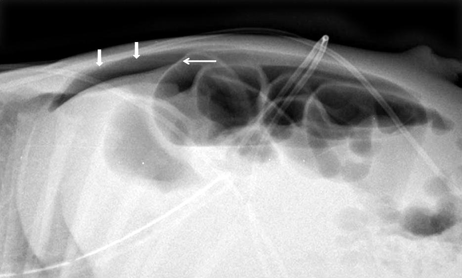 ases, or with tumors such as neuroblastoma, hepato- Normally, this separation should not exceed 2 mm. blastoma, and teratoma Fig. 3. Supine view of a normal neonate.