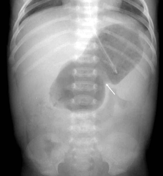 (air-portogram). Fig. 7. Hypertrophic pyloric stenosis. Supine view demonstrates over distension of the stomach and evidence of a peristaltic wave (arrow) along the gastric body.