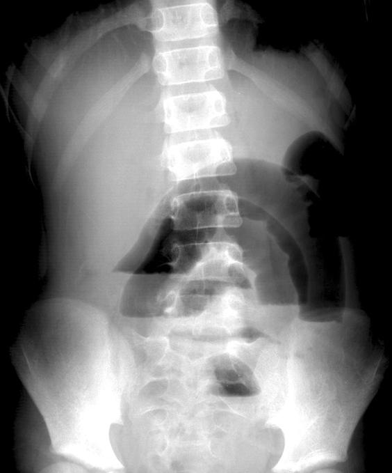 Hee Jung Lee:Plain Abdominal Radiography in Infants and Children ㆍ 135 Fig. 8. Adynamic ileus with gastroenteritis. The fluid levels tend to be long and are the same level on an erect view.