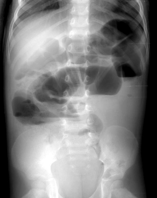 ted within a hernia sac, or gas in the bladder from a high anorectal malformation 4). 7) Gastroenteritis: The radiographic appearances are variable and mimic bowel obstruction or paralytic ileus.