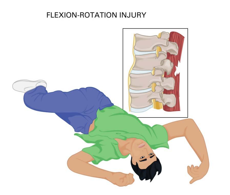 Common Mechanisms of Spine Injury Common mechanisms