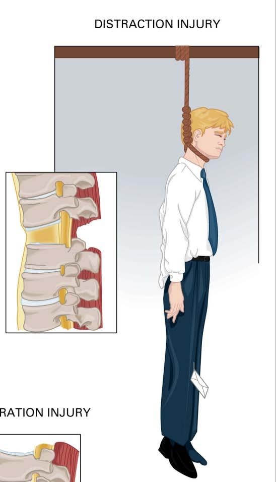 Common Mechanisms of Spine Injury Common