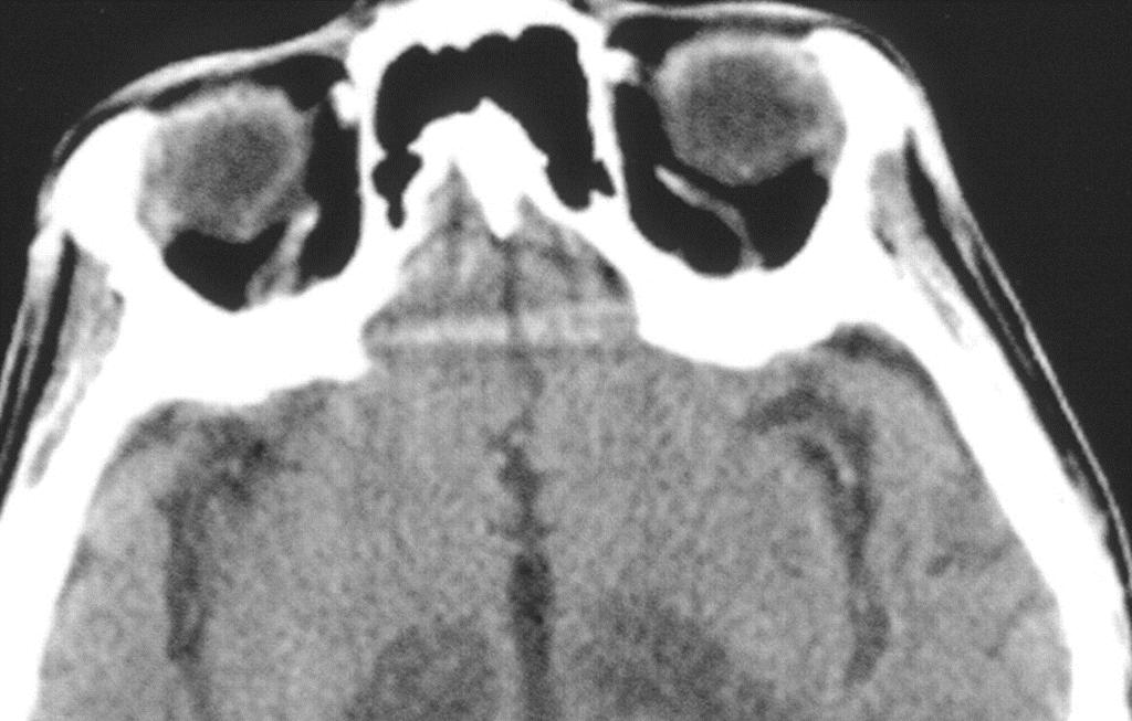 27-year-old man found at home with decreased level of consciousness, aphasia, and spastic