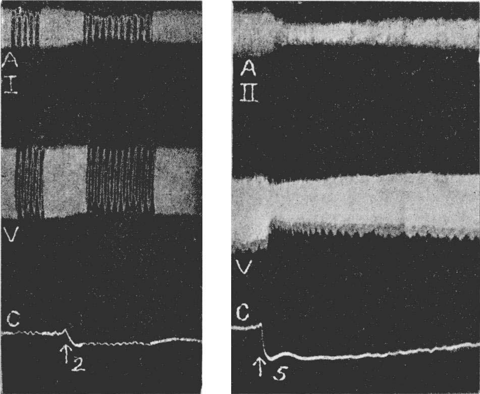The Influence of Sodium Evipan on the Heart and Circulation 107 ventricular contractions simultaneously with the carotid pressure.