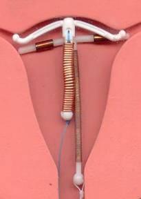 Intra-uterine devices Also under development: Swing: copper-releasing with coil stem IUD