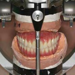 Figs 5A, 5B, 5C: Final prostheses articulated in the placement of 5 Brånemark implants, the surgical template