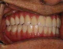 the standard Brånemark implants and then connected intraorally to the zygomatic implants.