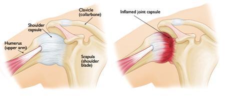 1 Frozen Shoulder What is frozen shoulder? Frozen shoulder, also called adhesive capsulitis, causes pain and stiffness in the shoulder. Over time, the shoulder becomes very hard to move.