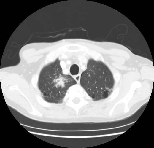Case 2 CT scan Summary: TB radiographs Tuberculosis has a myriad of radiographic appearances Chest x-rays are snapshots and can t determine if the disease is