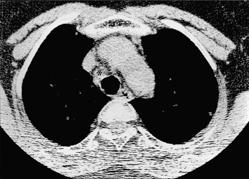 Results CT scans depicted numerous tiny 1 to 5-mm nodules distributed throughout both lungs. Nodules of more than 1.5 mm in diameter were seen in 81.
