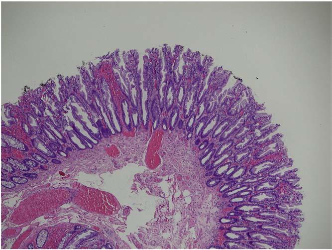 6 D. C. Snover Fig. 4 Microvesicular hyperplastic polyp. Note that the crypts are relatively straight with narrow bases (40). Also, see Fig. 3A.