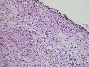 Tumor Issues Grade- 50% glands cutoff Low; well and moderately differentiated High; poor and