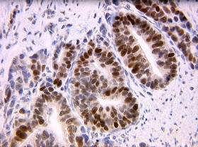 LS) MSI- tumor DNA IHC- tumor protein CRC with MMR