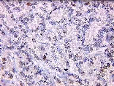 IHC - Problems in Interpretation Variability Weak nuclear staining Cytoplasmic staining Tissue and fixation? Columbus Area LS Study 1566 CRC; 19.6% MSI, 2.