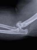 Radial Head Fractures Save or Replace? Current Solutions in Orthopedic Trauma Sepember 19, 2015 Jorge L. Orbay MD.