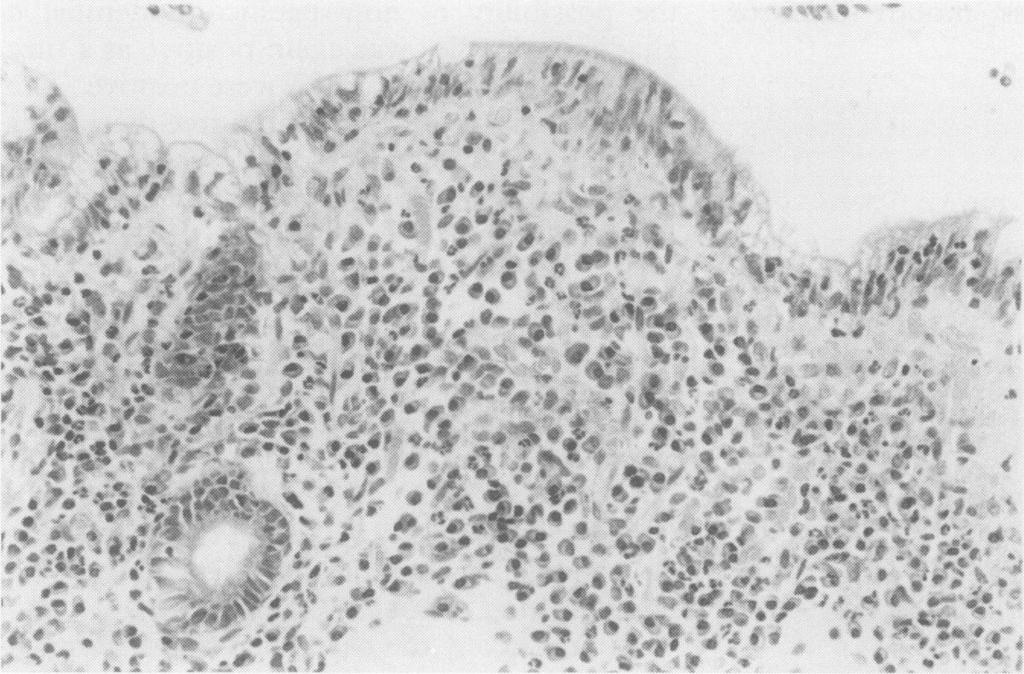 polymorphonuclear leucocyte infiltrate with extension upwards into the surface epithelium which also showed focal gastric metaplasia. The patient was discharged with oral iron supplements.