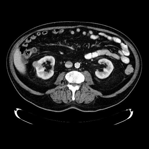 b c Slika 3. Solidni kortikalni tumor srednje trećine desnog bubrega.