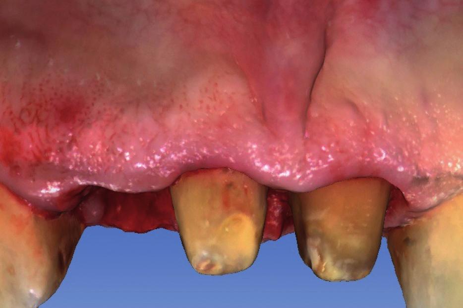 STL file buccal view after three months. Fig. 5. STL file buccal view after extraction of tooth 1.