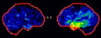 Semantic dementia Multimodal disorder with aphasia and agnosia Loss