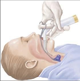 Protocol 14020 Airway Obstruction Pediatric Removal of reference to endotracheal intubation as an ALS option Laryngeal