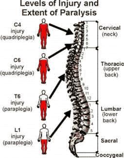 Definition Loss of motor power to both legs Paraparesis (paraplegia) refers to partial