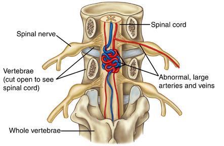 Spinal hemorrhage and vascular malformation Spinal hemorrhage-> spinal hematoma Subarachnoid hemorrhage Parenchymal hemorrhage Acute