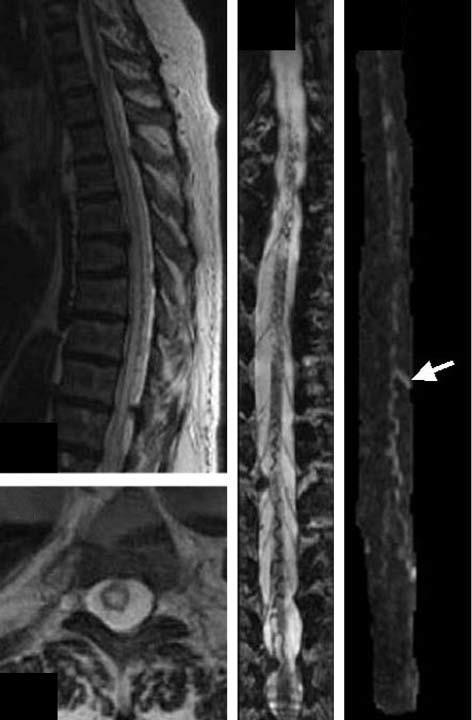 Spinal hemorrhage and vascular malformation Spinal fistula or
