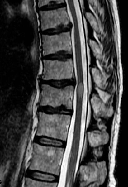 Acute Inflammatory spinal cord disorders Acute transverse myelitis Acute segmental spinal cord injury Could by infectious process Immunologically mediated (NMO) post