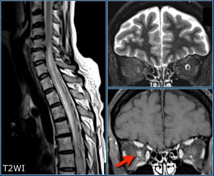Acute Inflammatory spinal cord disorders Neuromyelitis optica - Devic's disease simultaneous inflammation and demyelination of the optic nerve (optic neuritis) and the spinal cord (myelitis) Optic