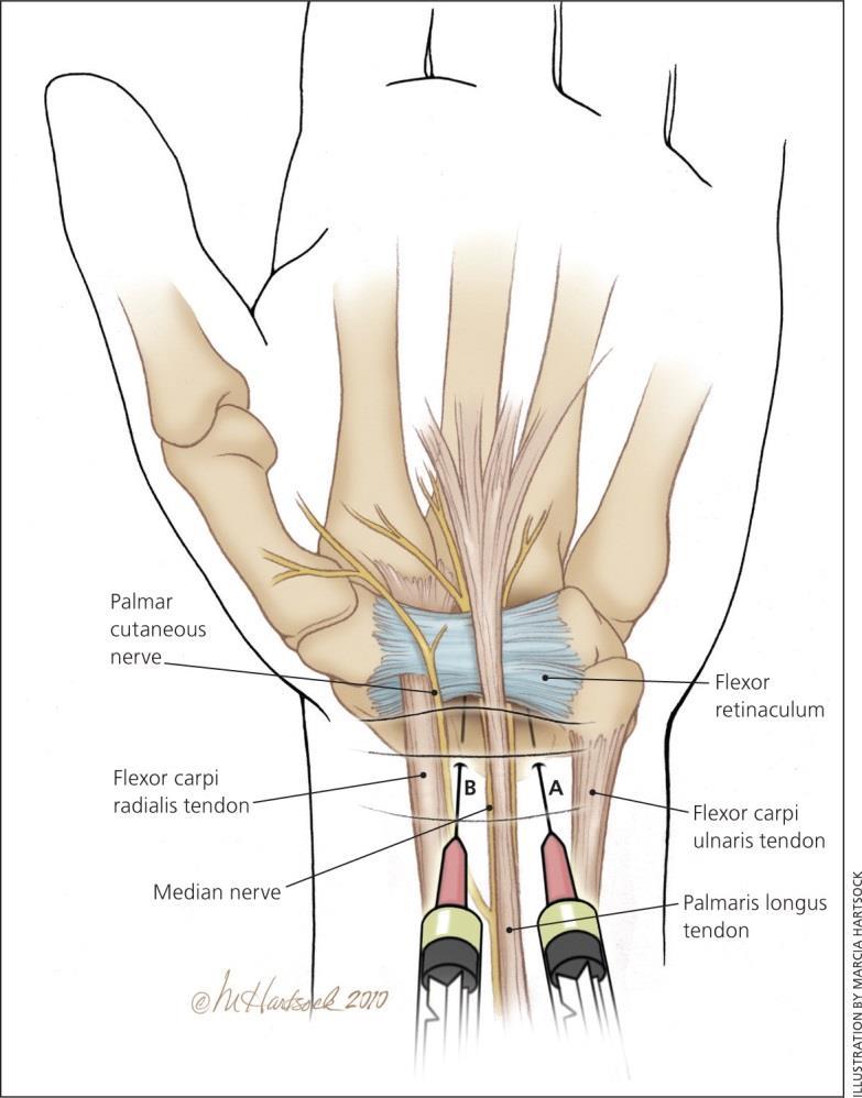 Carpal Tunnel Tip of the needle aimed here Ulnar